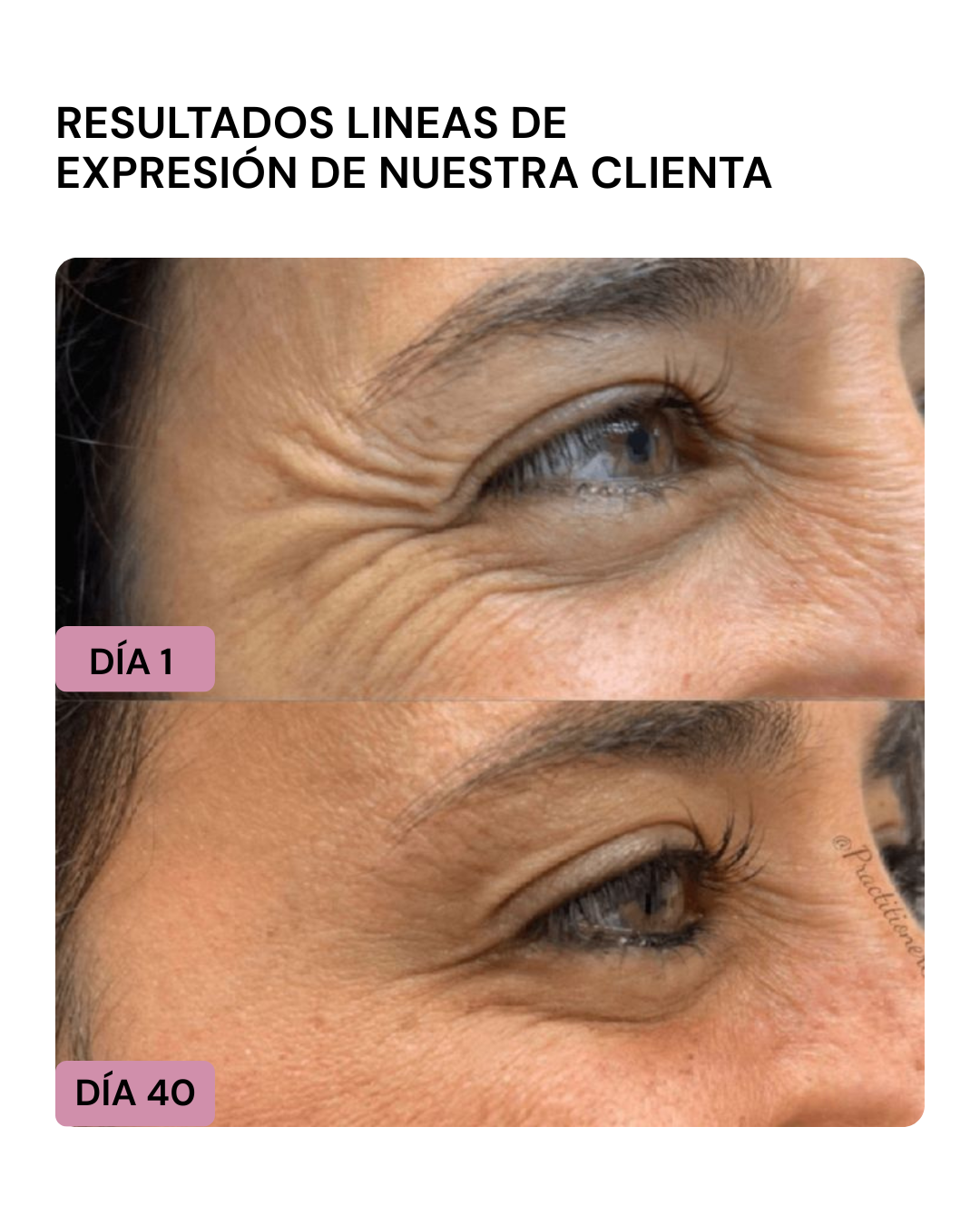 LIFTER 3D – Crema Tensora Efecto Botox, Antiarrugas, Antiflacidez y Reafirmante